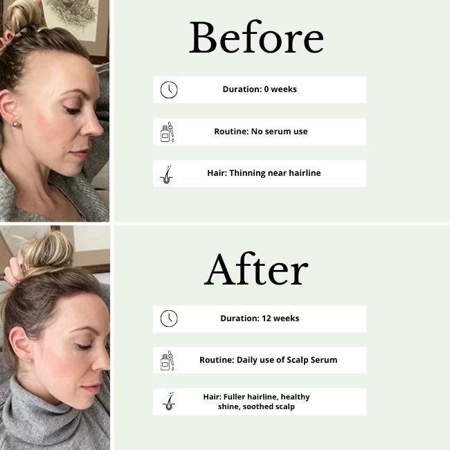 30ml scalp serum